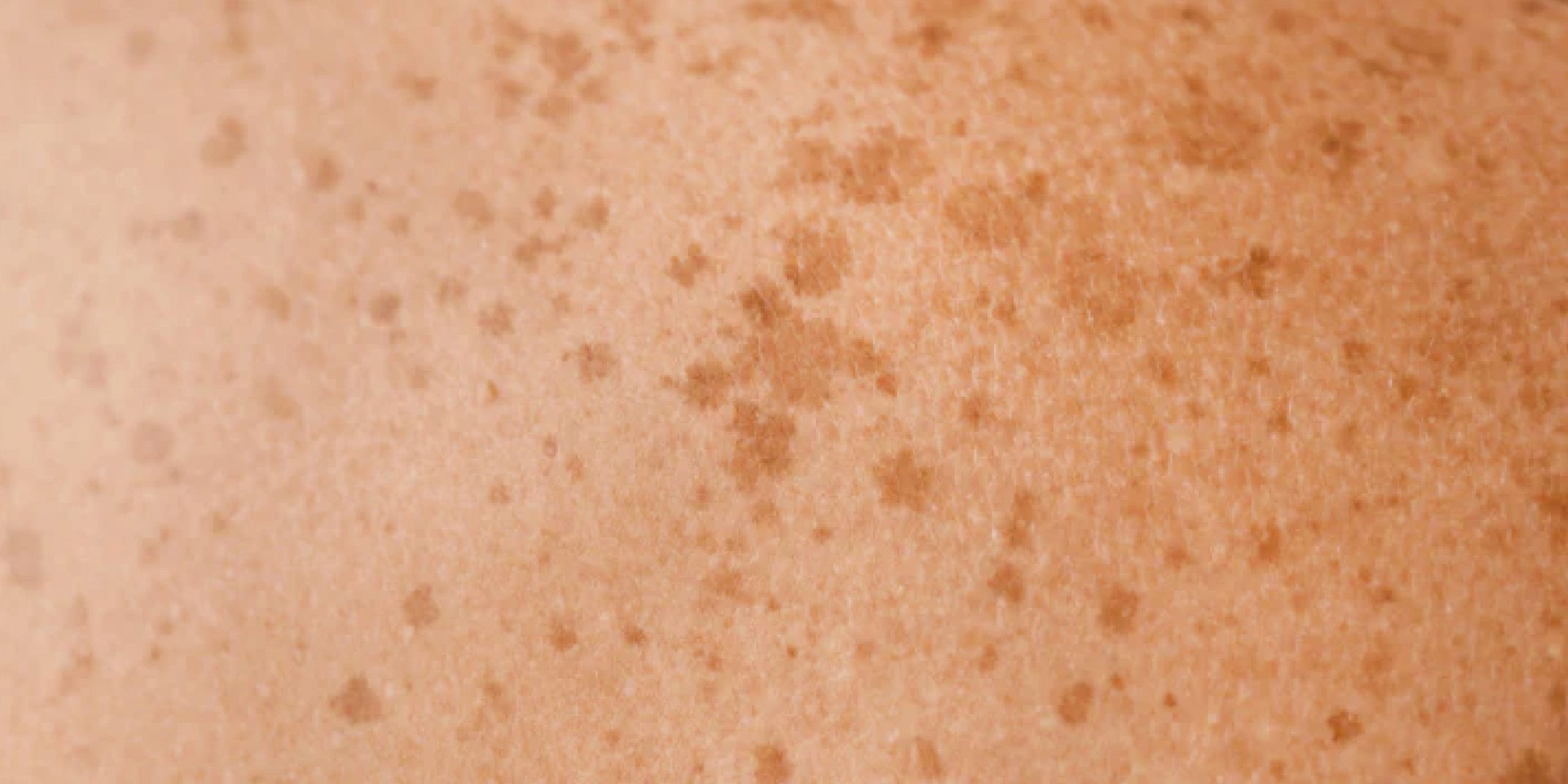 Pigmentation Problems
